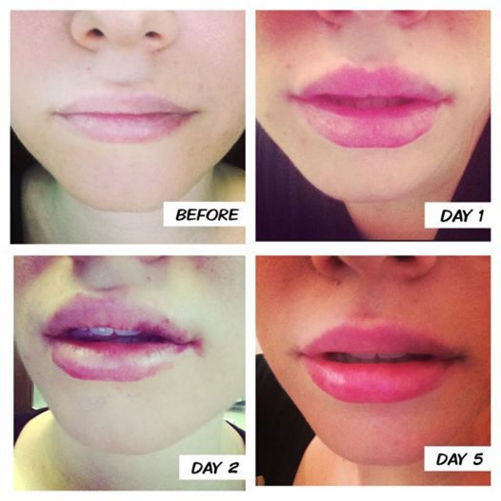 lip-filler-swelling-stages-here-s-what-to-expect-celebritystyleguide